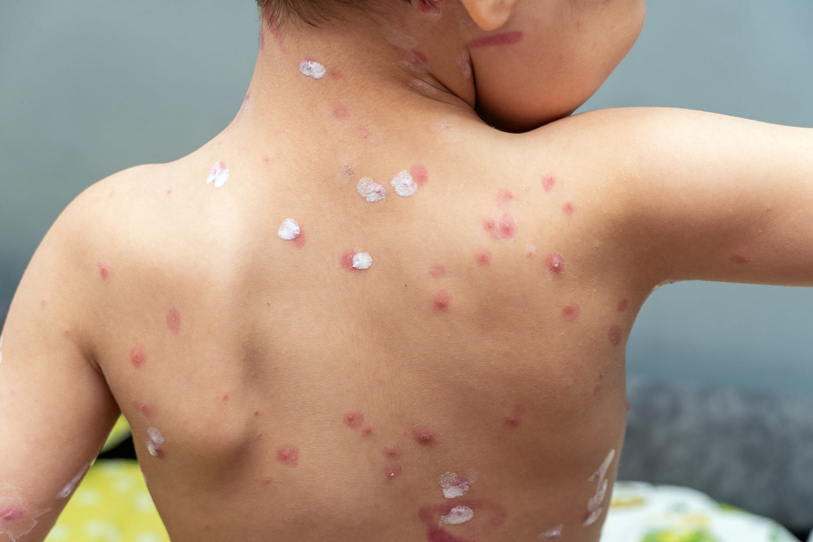 treatment ulcers from chickenpox varicella with medical cream kid skin