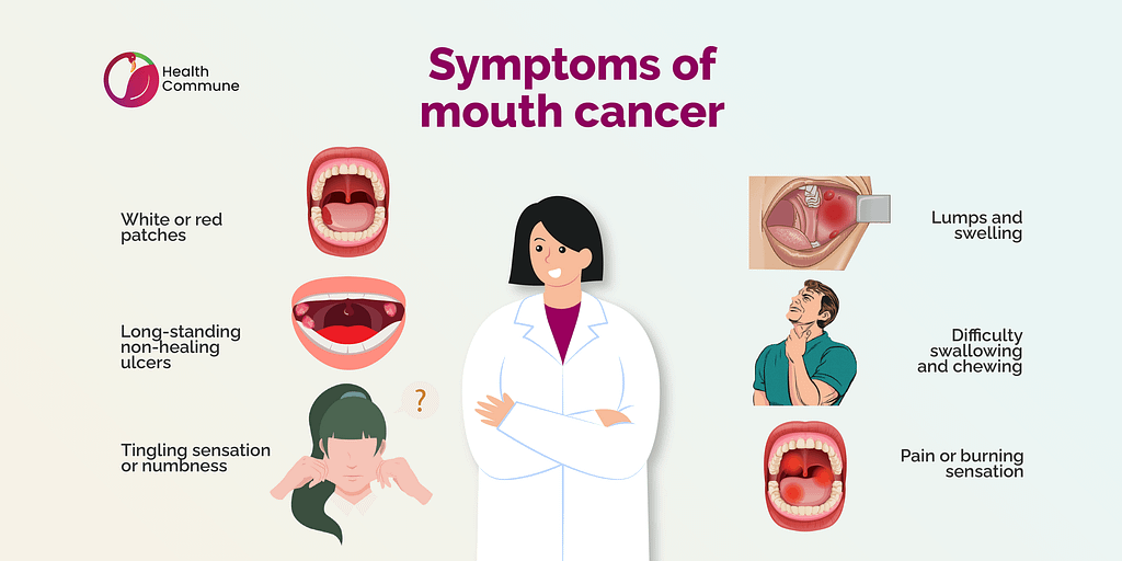 40. Mouth Cancer